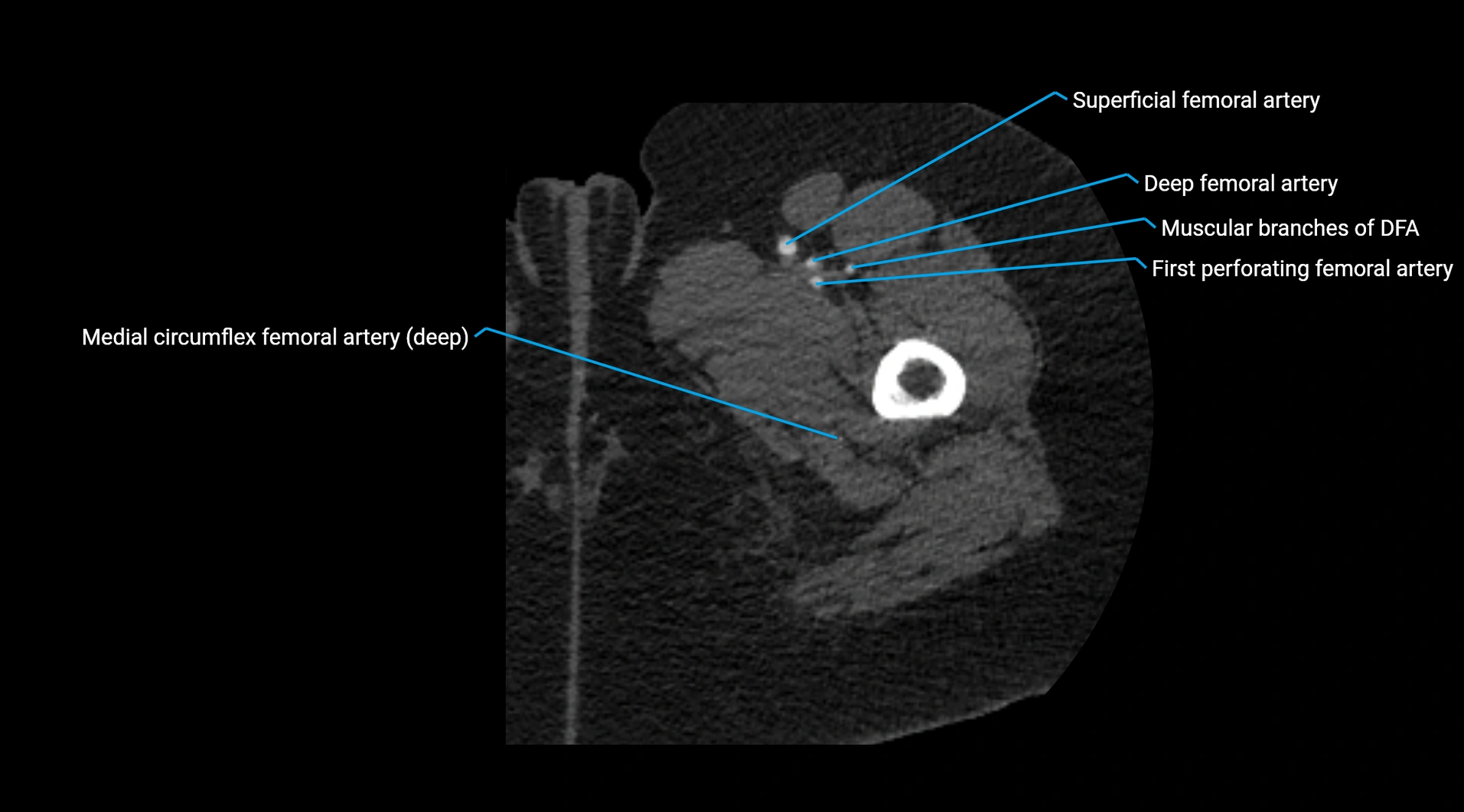 CTA lower limb cross sectional anatomy labelled image _81.webp